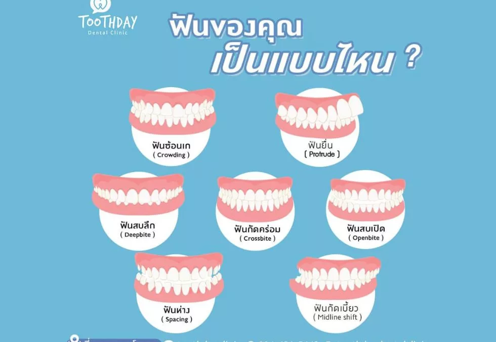 ฟันแบบไหนที่ควรจัดฟัน